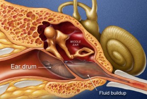 PRinc_rm_illustration_showing_middle_ear_infection