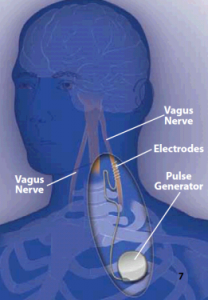 vns seizures chiropractic nerve vagus placement spine brain